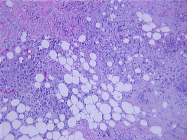 Cancer de la vessie chez la femme : un pronostic à long terme meilleur que prévu