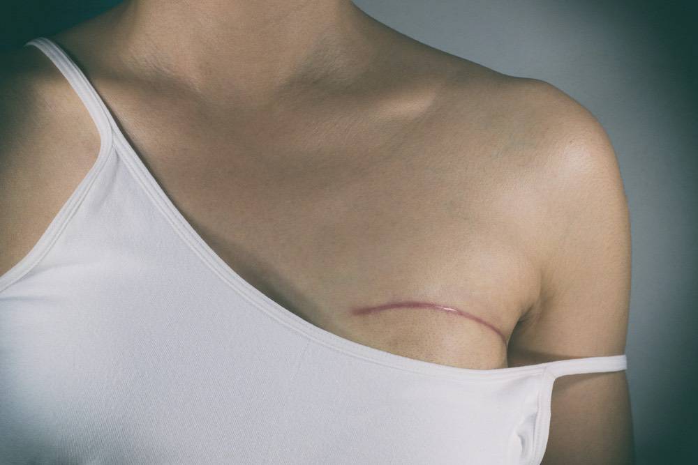Mastectomie bilatérale prophylactique avec reconstruction immédiate : quel taux de satisfaction ?