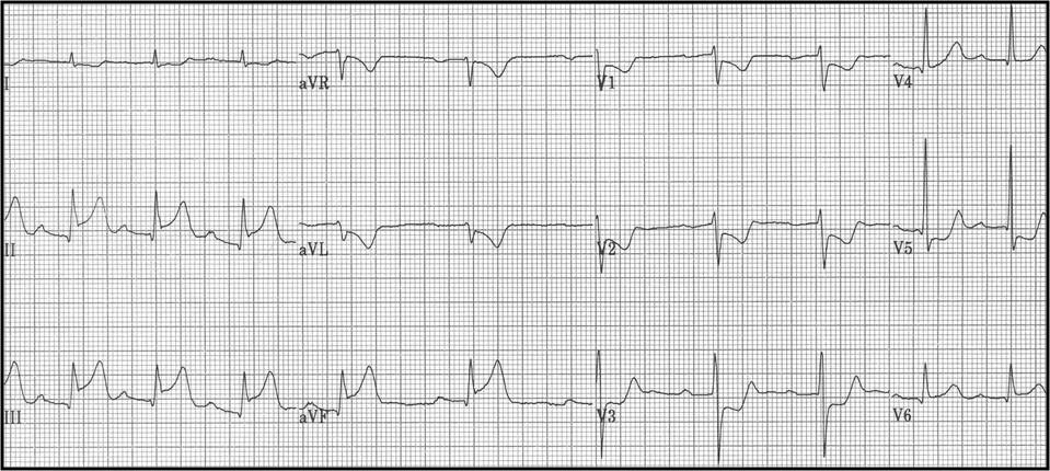 Diabète de type 2 : influence du sexe sur les complications cardiovasculaires