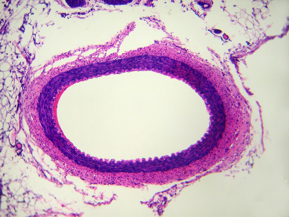 Artériopathie périphérique des membres inférieurs chez les femmes