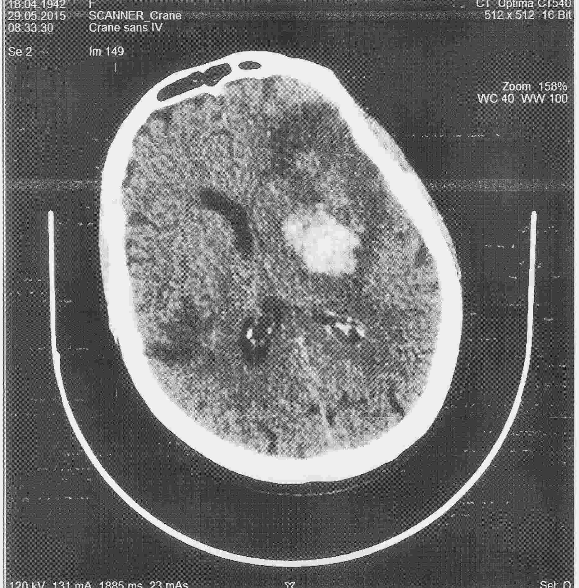 Tomodensitométrie. Deux AVC (zones hypodenses) dont un avec transformation hémorragique (zone arrondie hyperdense). Contre-indication à la thrombolyse.