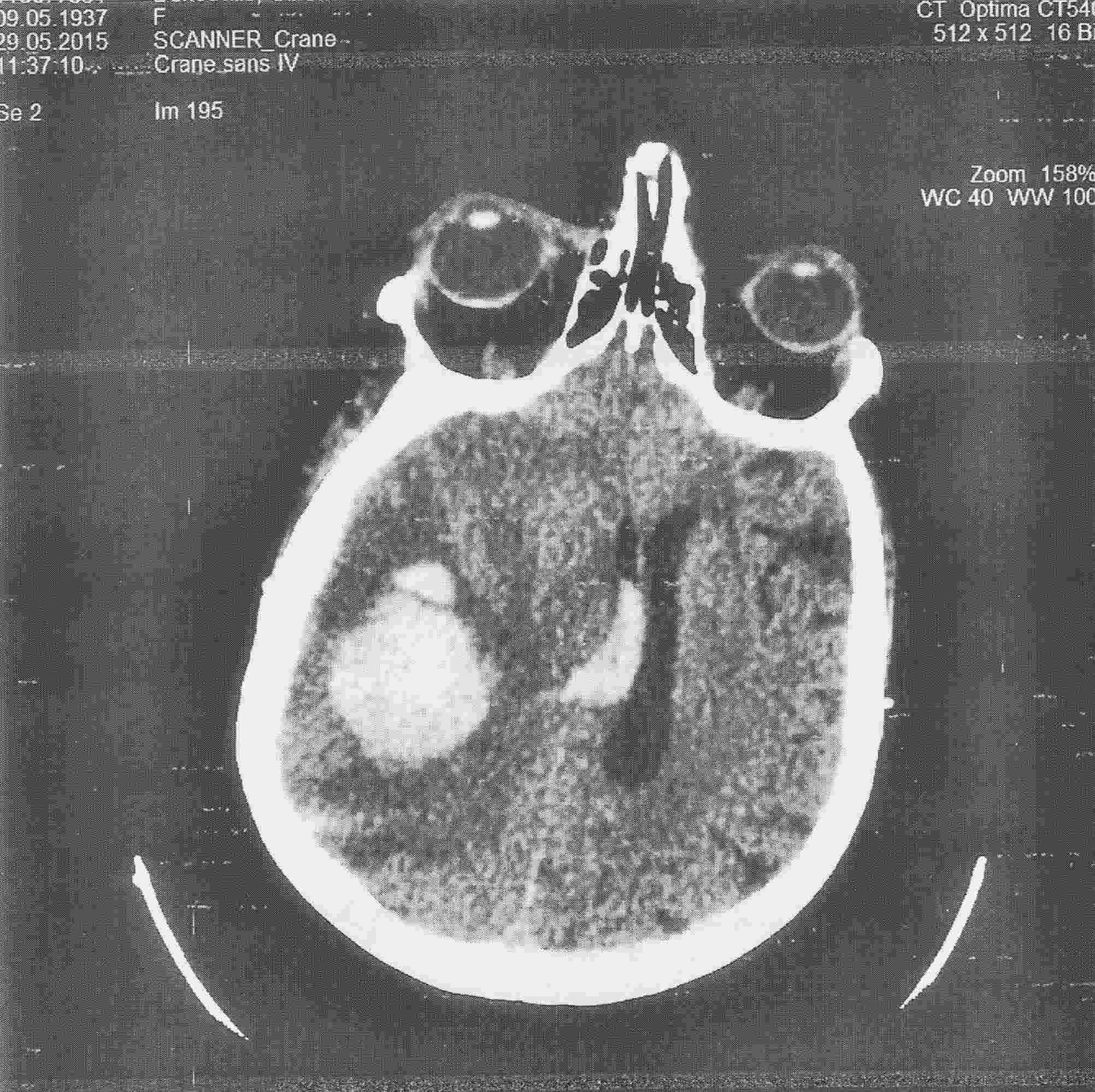 Tomodensitométrie. Infarctus cérébral massif sylvien droit hémorragique avec inondation ventriculaire.