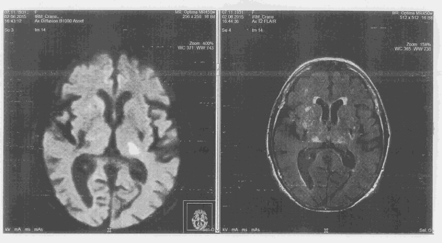 Figure 3. IRM sans injection de produit de contraste ; IRMdiffusion (gauche) : hypersignal capsulaire gauche ; IRMséquences FLAIR (droite) : hypersignal capsulaire gauche concordant ; En l’absence de mismatch diffusion/FLAIR : pas d’indication pour lathrombolyse.
