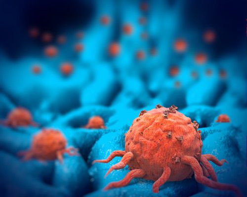 Endométriose et risque de cancers non gynécologiques