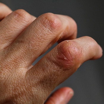 Les femmes atteintes de rhumatisme psoriasique répondent moins bien aux anti-TNF