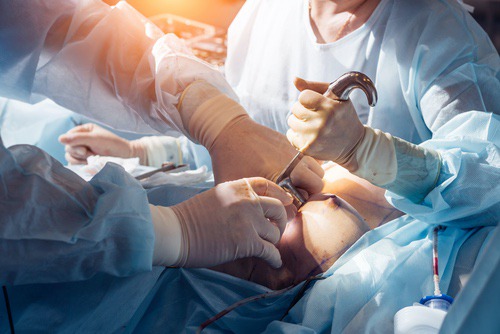 Contracture capsulaire après chirurgie mammaire : des facteurs de risque identifiés
