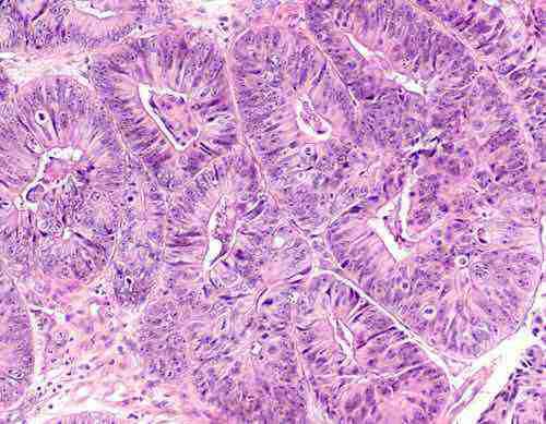 Cancer de l’endomètre : plusieurs changements notables en 40 ans