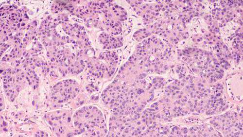 Diagnostic du cancer de la vessie : une inégalité de genre