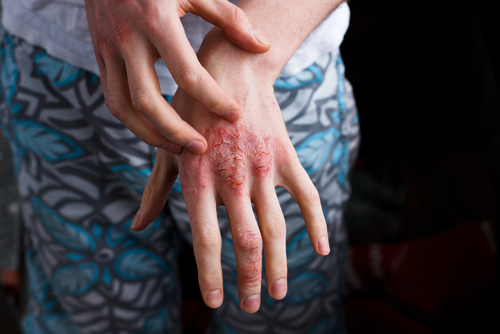 Psoriasis sous biothérapie: les femmes ont plus d’infections aigües que les hommes