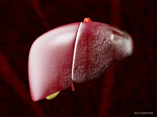 Carcinome hépatocellulaire : des disparités liées au genre