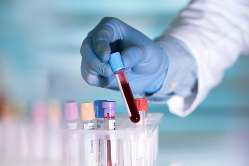 Parkinson: l’hyperhomocystinémie, biomarqueur différent chez la femme et l’homme