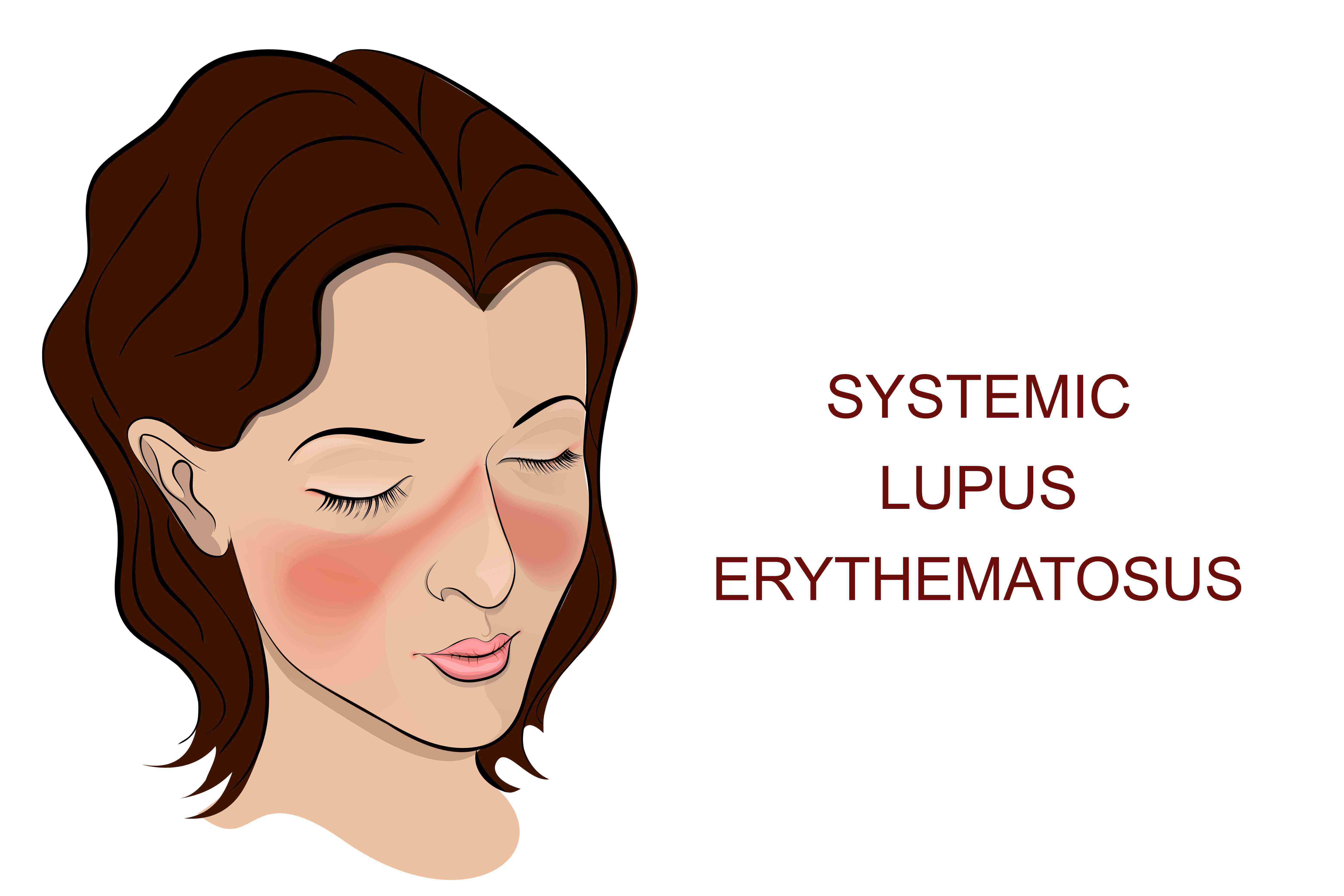 Le lupus systémique, un frein à la vie de couple ?