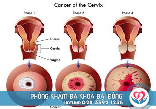 Bệnh viêm lộ tuyến cổ tử cung qua từng cấp độ