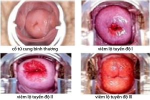 Bị ngứa vùng kín do viêm lộ tuyến cổ tử cung
