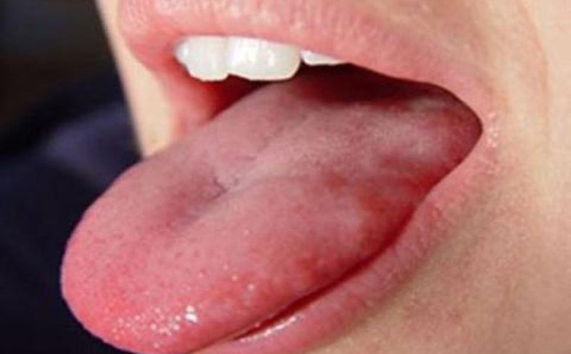 Lưỡi nổi mụn thịt đỏ