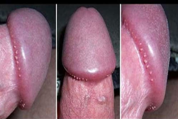 Hình ảnh đặc điểm các mụn sùi ở dương vật nam