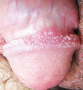 Hình ảnh những mụn sùi đầu tiên mọc riêng lẻ tại rãnh quy đầu