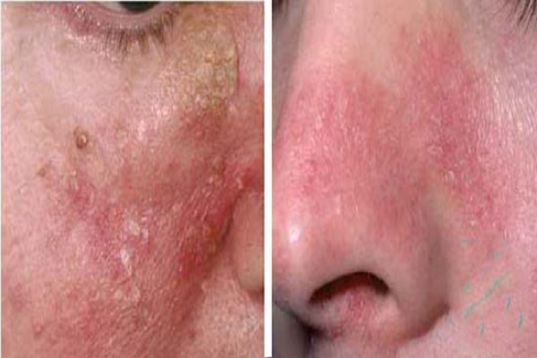Viêm da tiết bã là gì, tự hết không? Nguyên nhân và cách trị tận gốc