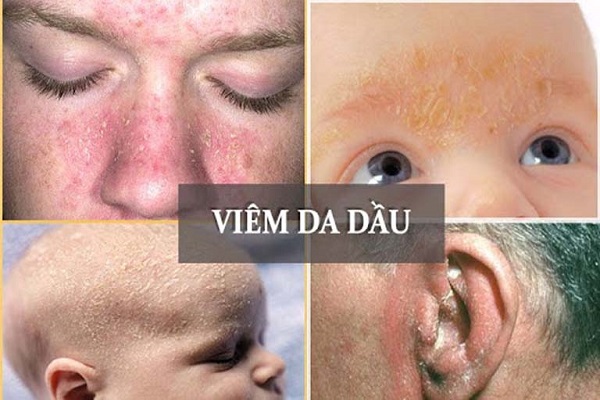 Viêm da tiết bã là gì, tự hết không? Nguyên nhân và cách trị tận gốc