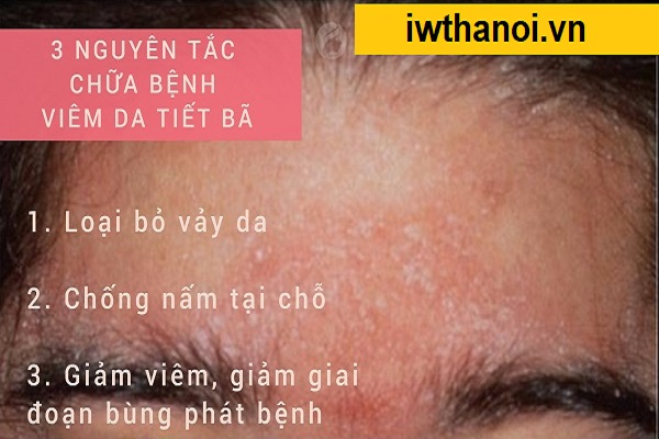 Viêm da tiết bã là gì, tự hết không? Nguyên nhân và cách trị tận gốc