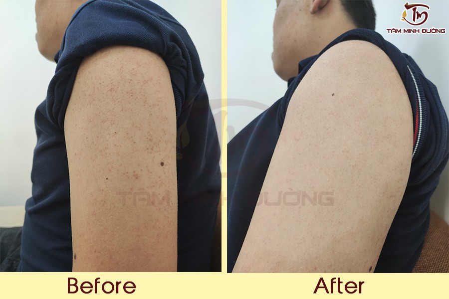 Viêm da tiết bã là gì, tự hết không? Nguyên nhân và cách trị tận gốc