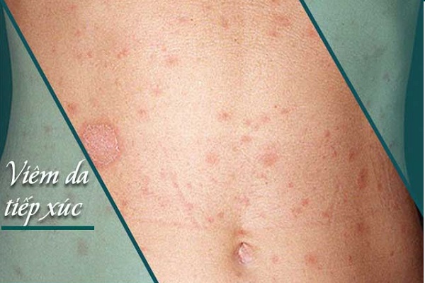 Bệnh viêm da tiếp xúc là gì? Nguyên nhân, biểu hiện và cách điều trị hiệu quả