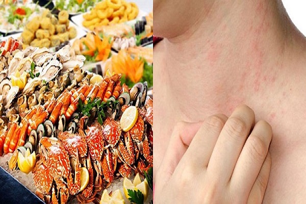 Bệnh viêm da tiếp xúc là gì? Nguyên nhân, biểu hiện và cách điều trị hiệu quả