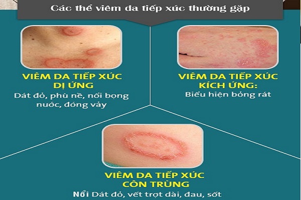 Bệnh viêm da tiếp xúc là gì? Nguyên nhân, biểu hiện và cách điều trị hiệu quả