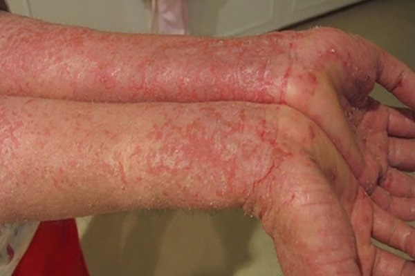 Viêm da dị ứng là gì? Nguyên nhân, dấu hiệu và biện pháp điều trị