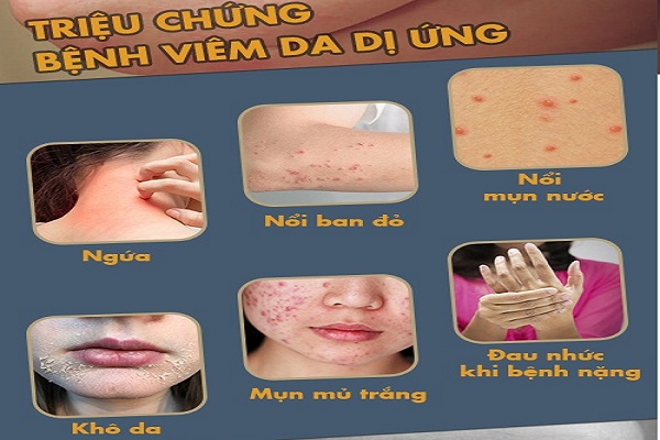 Viêm da dị ứng là gì? Nguyên nhân, dấu hiệu và biện pháp điều trị