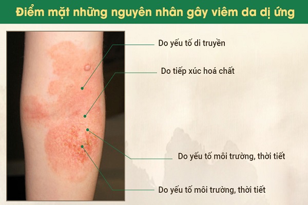 Viêm da dị ứng là gì? Nguyên nhân, dấu hiệu và biện pháp điều trị