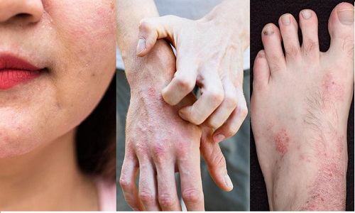 Viêm da cơ địa ở người lớn: Tác nhân gây bệnh và hướng chữa trị tốt nhất