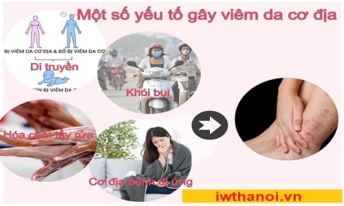 Viêm da cơ địa ở người lớn: Tác nhân gây bệnh và hướng chữa trị tốt nhất