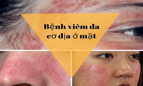 Viêm da cơ địa ở mặt, môi gây tróc vẩy, lột da nên làm gì?