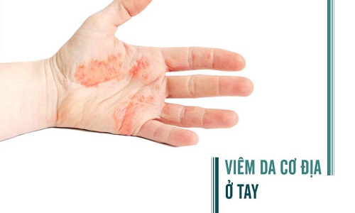 Bệnh viêm da cơ địa ở tay: Giai đoạn và cách chữa trị tận gốc