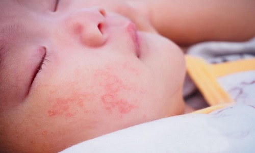 Viêm da cơ địa ở trẻ sơ sinh: Cách chữa và chăm sóc bé tốt nhất