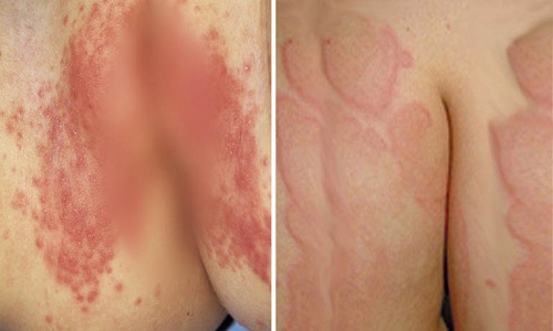 Viêm da cơ địa ở mông gây ngứa, nổi mẩn đỏ và cách can thiệp