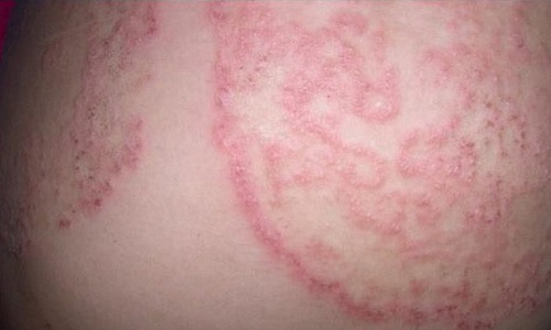 Viêm da cơ địa ở mông gây ngứa, nổi mẩn đỏ và cách can thiệp