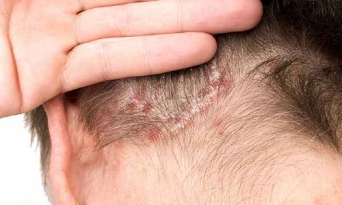Viêm da đầu cơ địa gây đỏ, ngứa và cách chữa bệnh tại nhà