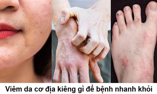 Bị viêm da cơ địa kiêng gì trong sinh hoạt và ăn uống để bệnh mau khỏi?