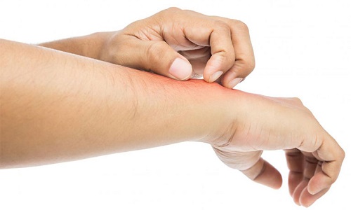 Bị viêm da cơ địa kiêng gì trong sinh hoạt và ăn uống để bệnh mau khỏi?