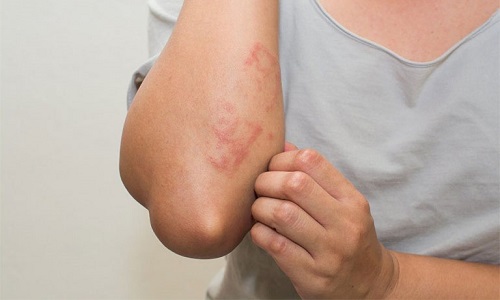 Nước Anolyte chữa viêm da cơ địa có tốt không? Tác dụng và cách dùng