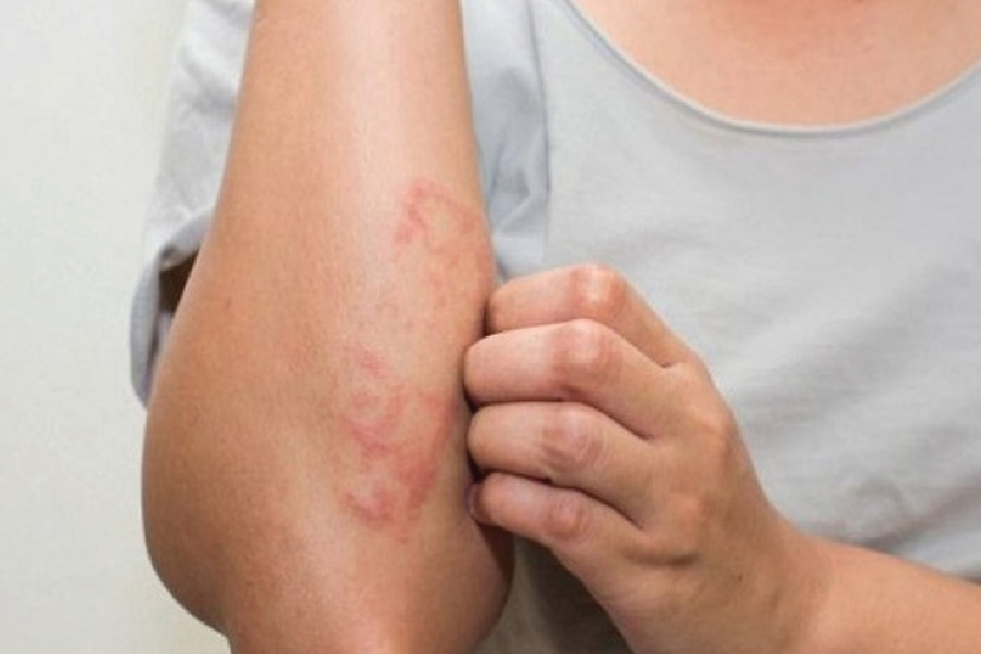 Viêm da cơ địa là gì? Triệu chứng, nguyên nhân và cách chữa trị tại nhà