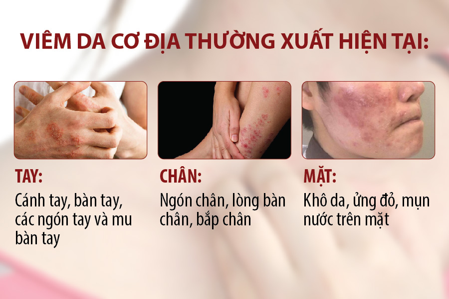 Viêm da cơ địa là gì? Triệu chứng, nguyên nhân và cách chữa trị tại nhà