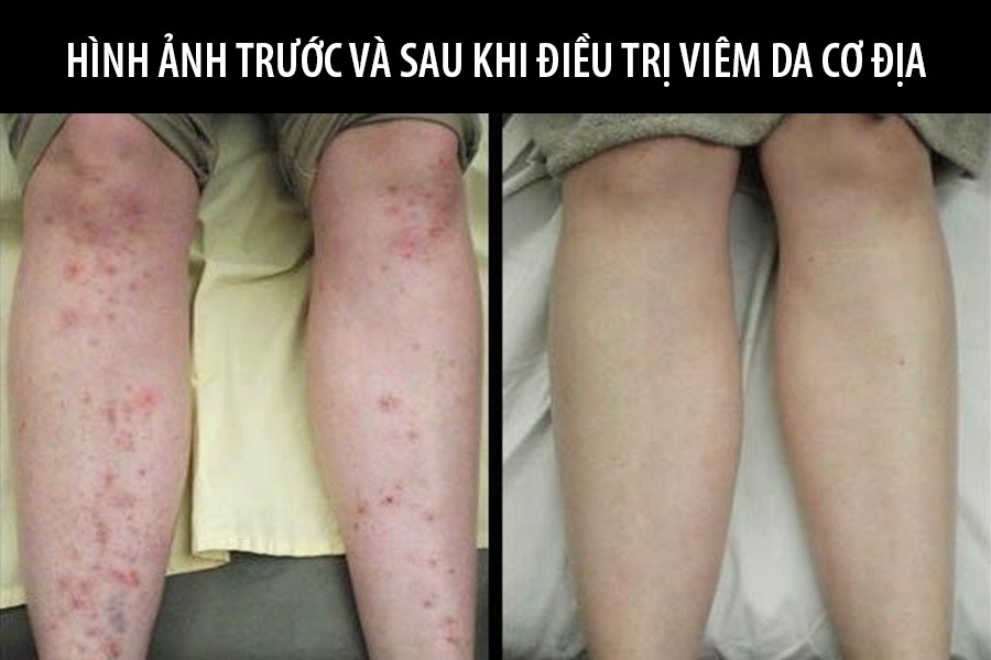 Viêm da cơ địa là gì? Triệu chứng, nguyên nhân và cách chữa trị tại nhà