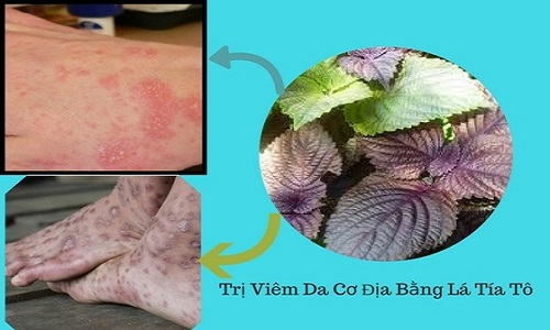 Chữa viêm da cơ địa bằng lá tía tô: Công dụng và cách tắm bằng lá