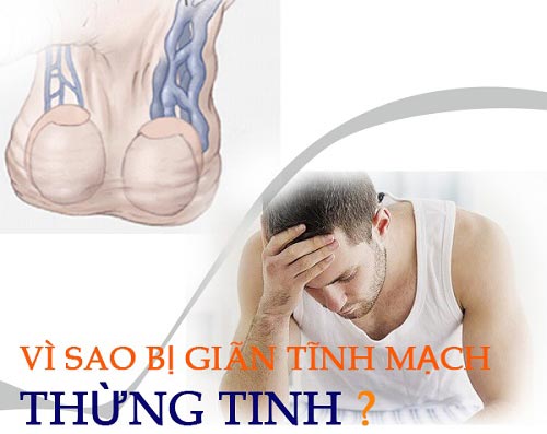 Nguyên nhân giãn tĩnh mạch tinh hoàn