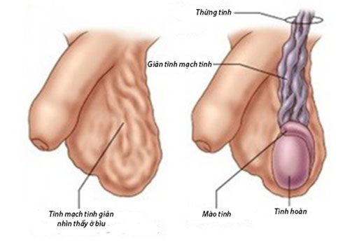 Hình ảnh giãn tĩnh mạch tinh hoàn