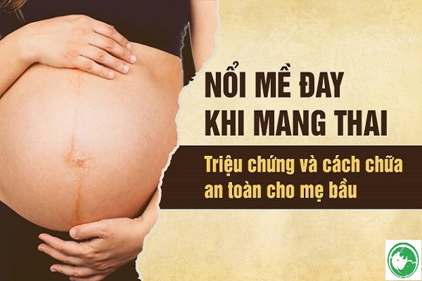 Nổi mề đay khi mang thai 3 tháng đầu, tháng cuối và cách xử lý