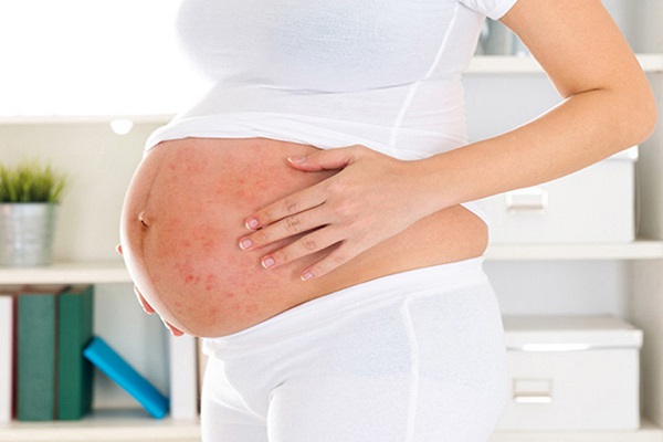 Nổi mề đay khi mang thai 3 tháng đầu, tháng cuối và cách xử lý